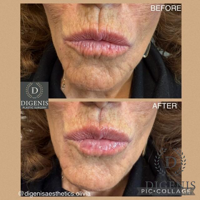 Injectables: Patient 4 - Before and After  
