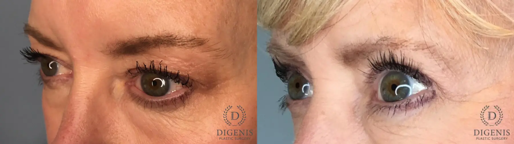Eyelid Surgery: Patient 80 - Before and After 2