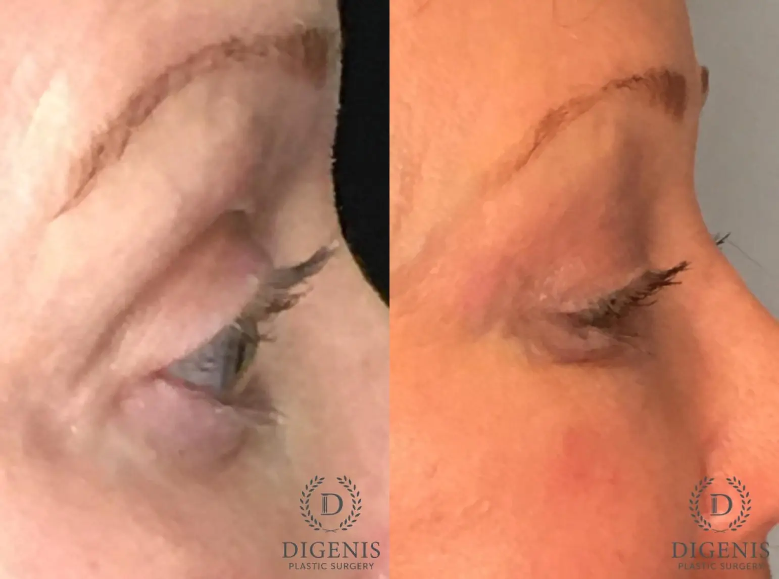 Eyelid Surgery: Patient 53 - Before and After 5