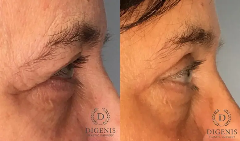 Eyelid Surgery: Patient 68 - Before and After 5