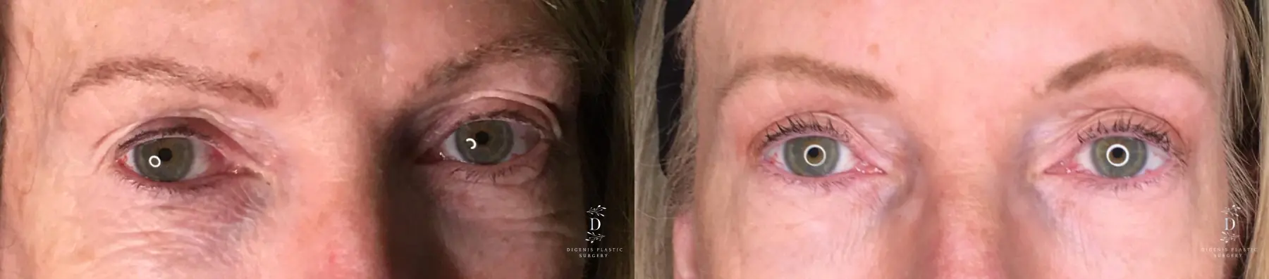 Eyelid Surgery: Patient 23 - Before and After 1