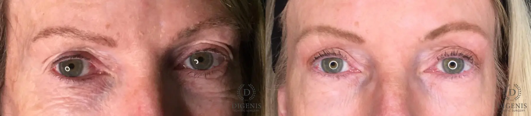 Eyelid Surgery: Patient 23 - Before and After  