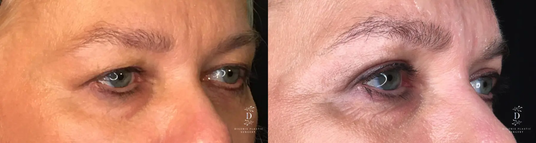 Eyelid Surgery: Patient 21 - Before and After 4