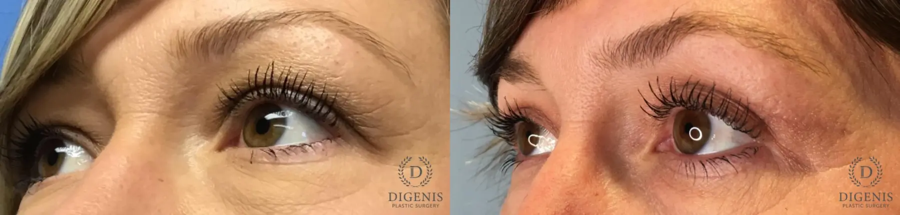 Eyelid Surgery: Patient 63 - Before and After 2