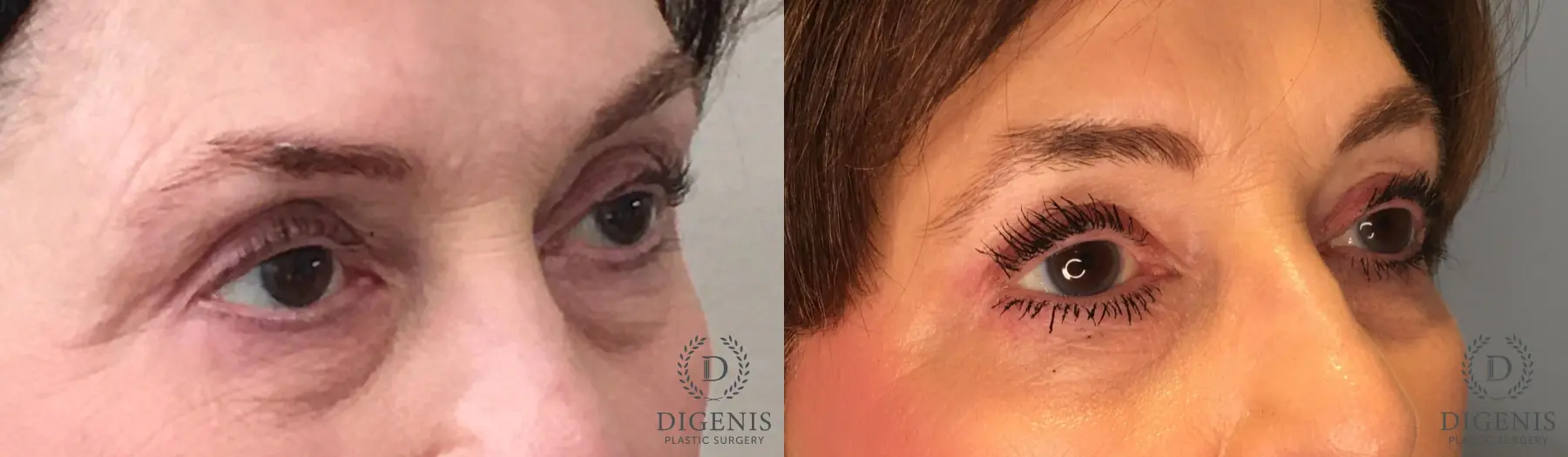 Eyelid Surgery: Patient 57 - Before and After 2