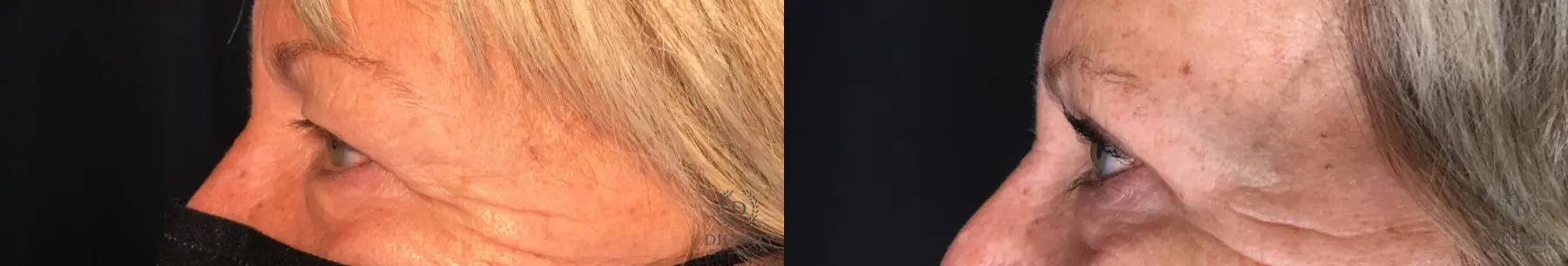 Eyelid Surgery: Patient 55 - Before and After 5