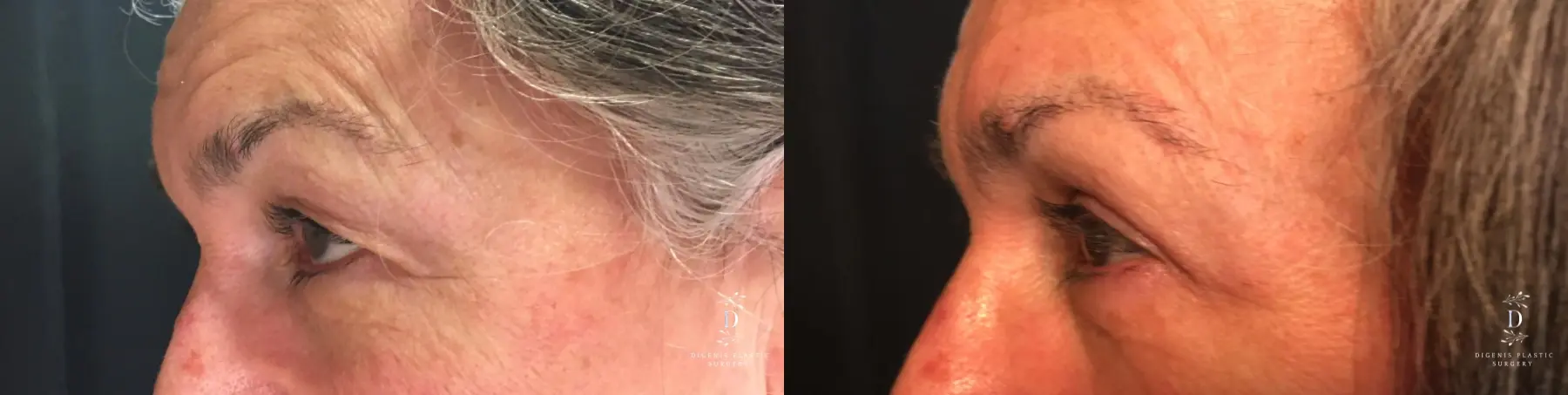 Eyelid Surgery: Patient 22 - Before and After 5