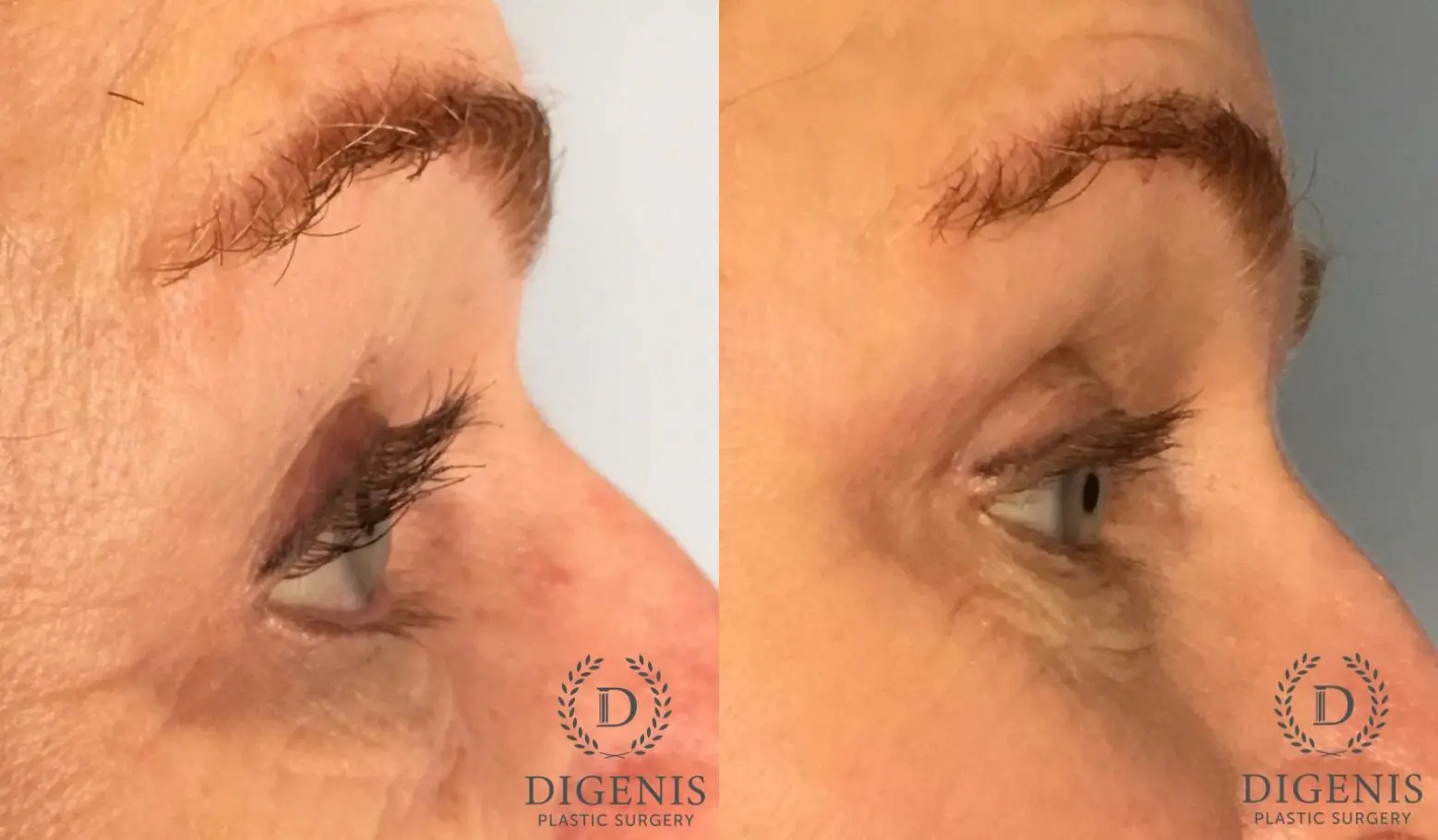Eyelid Surgery: Patient 71 - Before and After 5