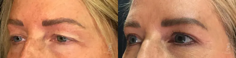 Eyelid Surgery: Patient 13 - Before and After 4