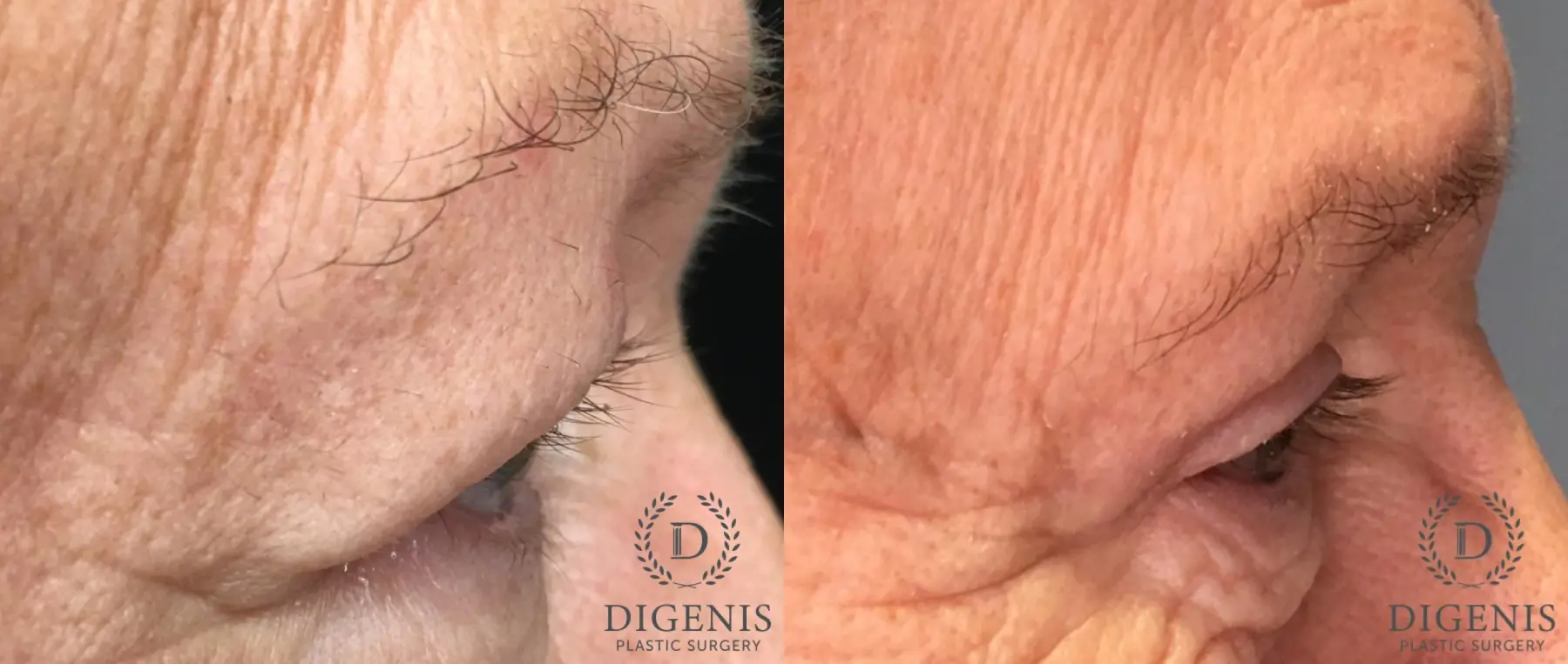 Eyelid Surgery: Patient 61 - Before and After 6
