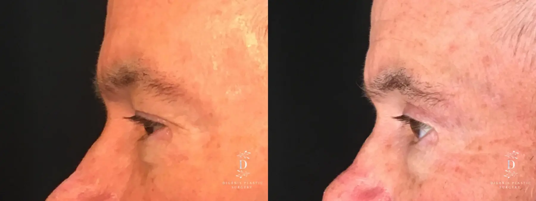 Eyelid Surgery: Patient 19 - Before and After 5