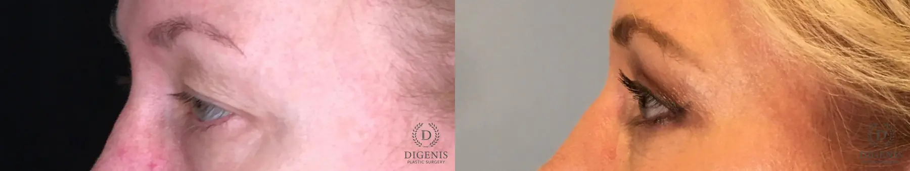 Eyelid Surgery: Patient 51 - Before and After 3