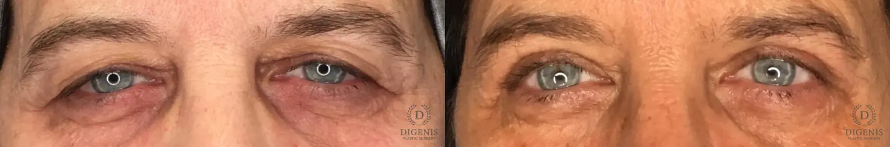 Eyelid Surgery: Patient 68 - Before and After 1