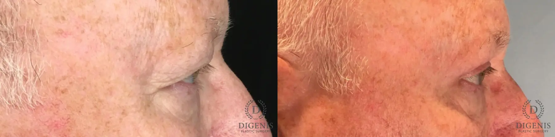 Eyelid Surgery: Patient 54 - Before and After 3