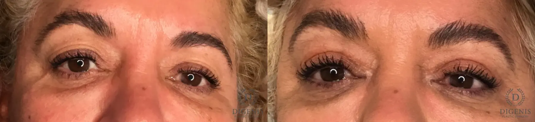 Eyelid Surgery: Patient 13 - Before and After  