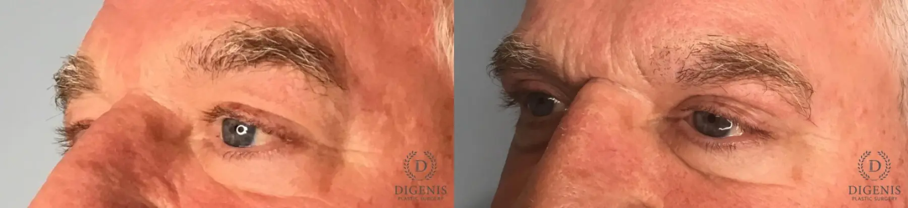 Eyelid Surgery: Patient 8 - Before and After 2