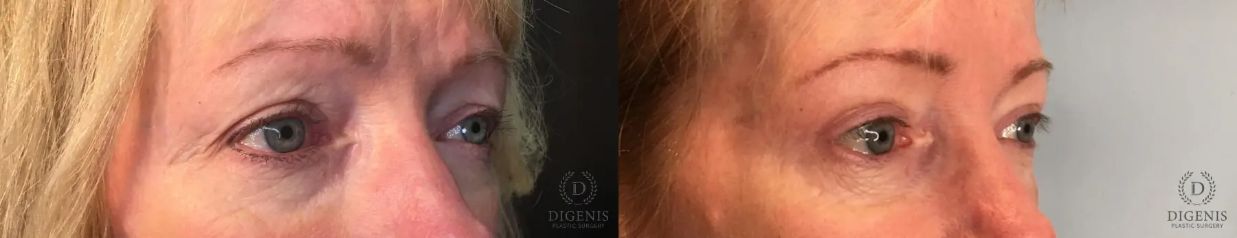 Eyelid Surgery: Patient 34 - Before and After 2