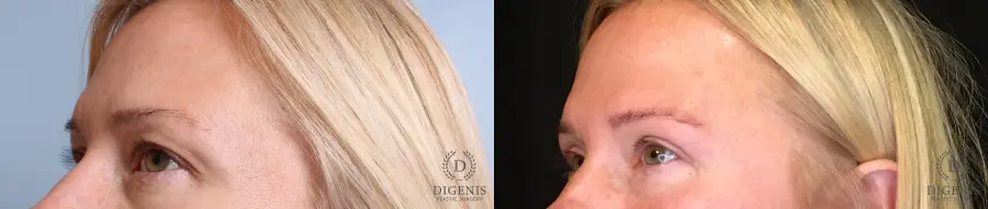 Eyelid Surgery: Patient 10 - Before and After 3