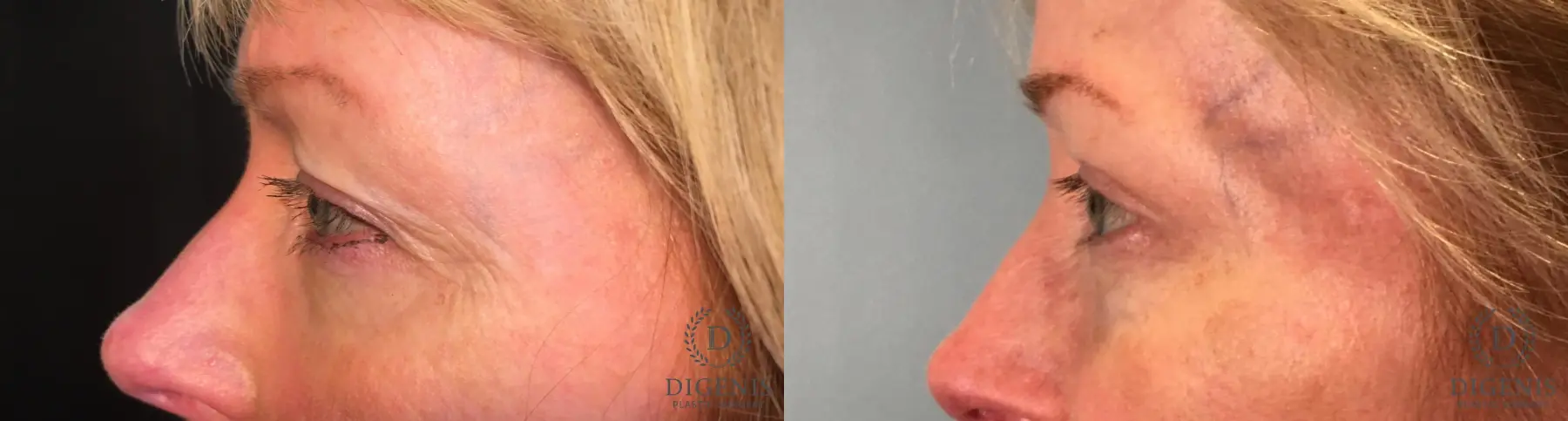 Eyelid Surgery: Patient 34 - Before and After 5