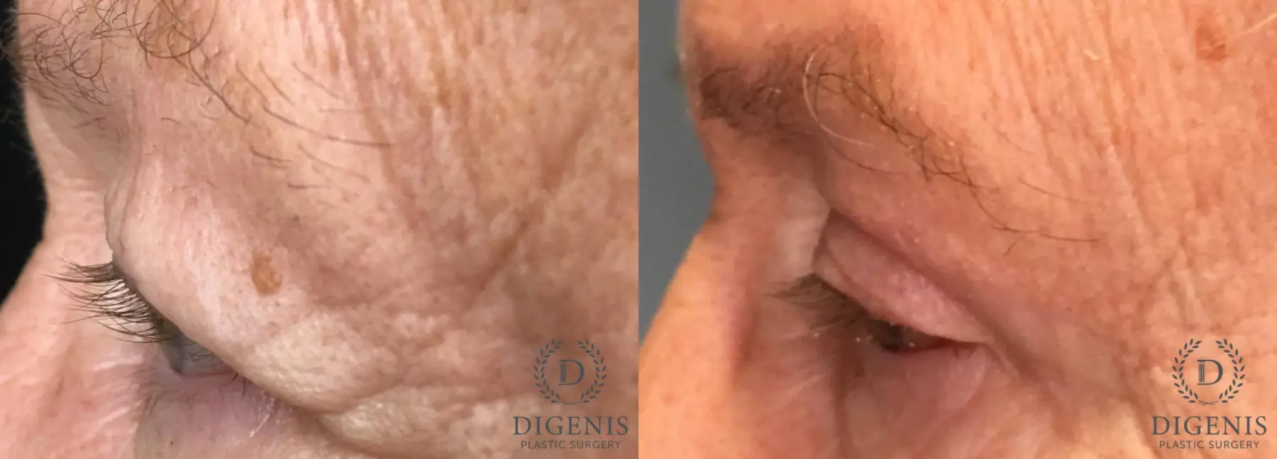 Eyelid Surgery: Patient 61 - Before and After 3