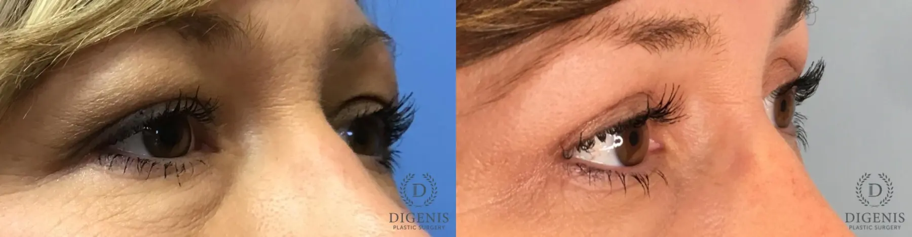Eyelid Surgery: Patient 63 - Before and After 4