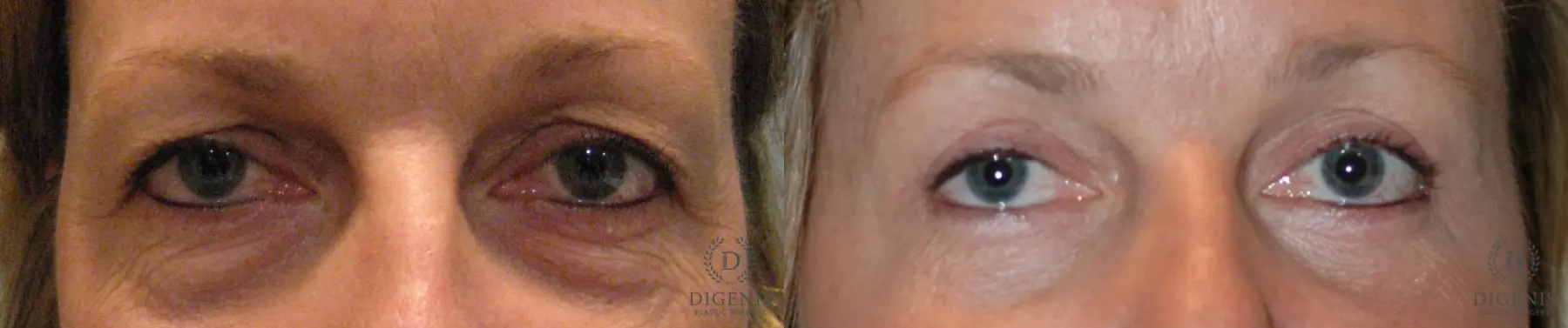 Eyelid Surgery: Patient 9 - Before and After  