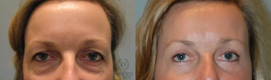 Eyelid Surgery: Patient 9 - Before and After 1
