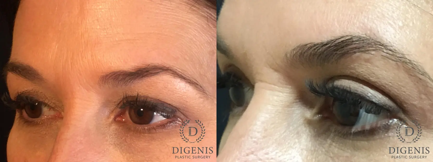 Eyelid Surgery: Patient 30 - Before and After 4