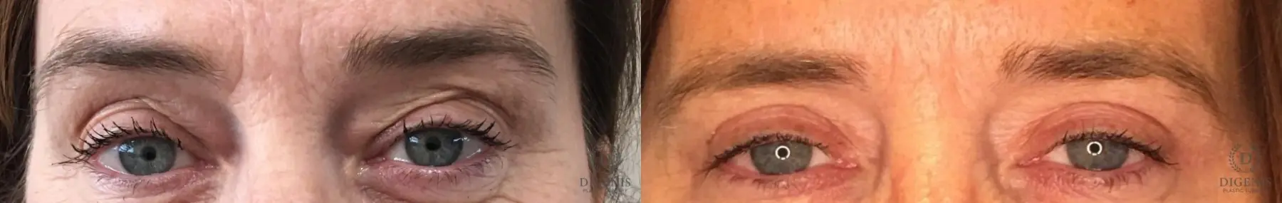 Eyelid Surgery: Patient 60 - Before and After  