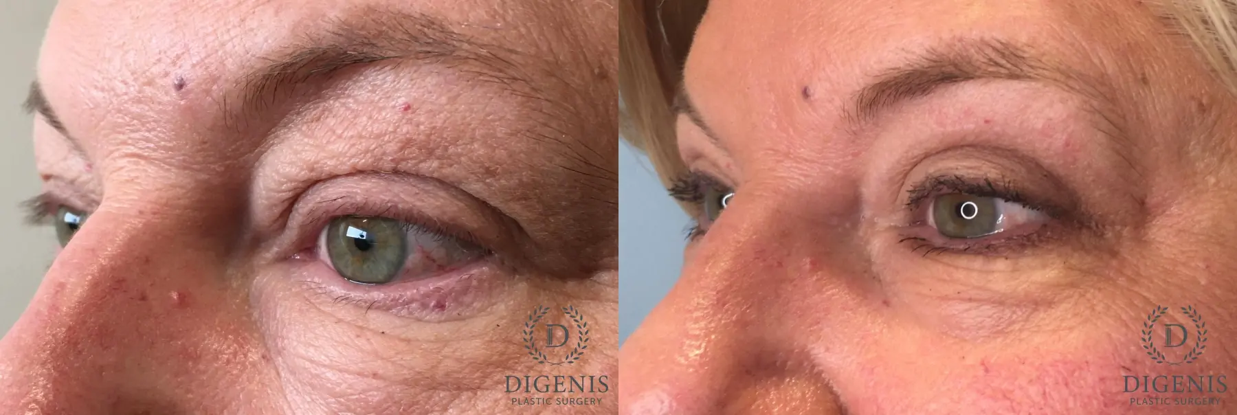 Eyelid Surgery: Patient 62 - Before and After 5