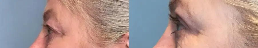 Eyelid Surgery: Patient 80 - Before and After 3