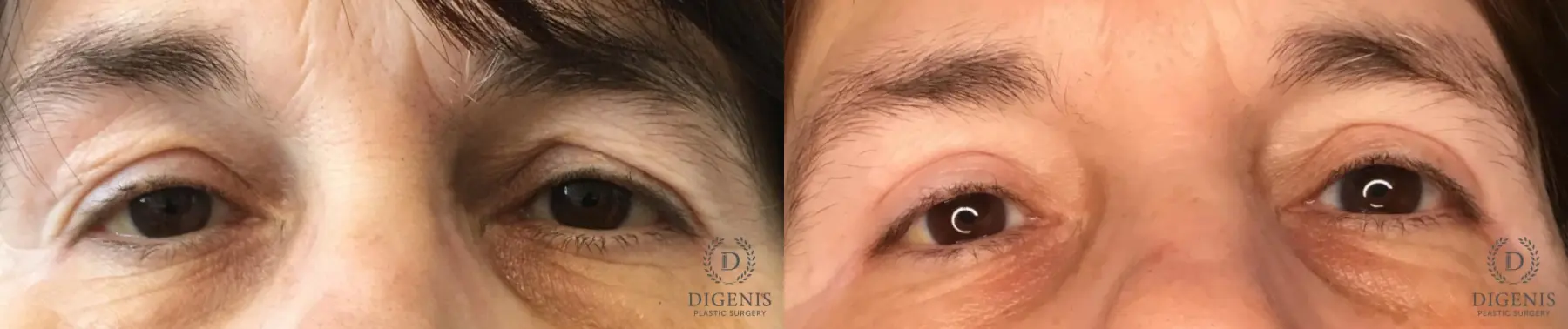 Eyelid Surgery: Patient 64 - Before and After 1