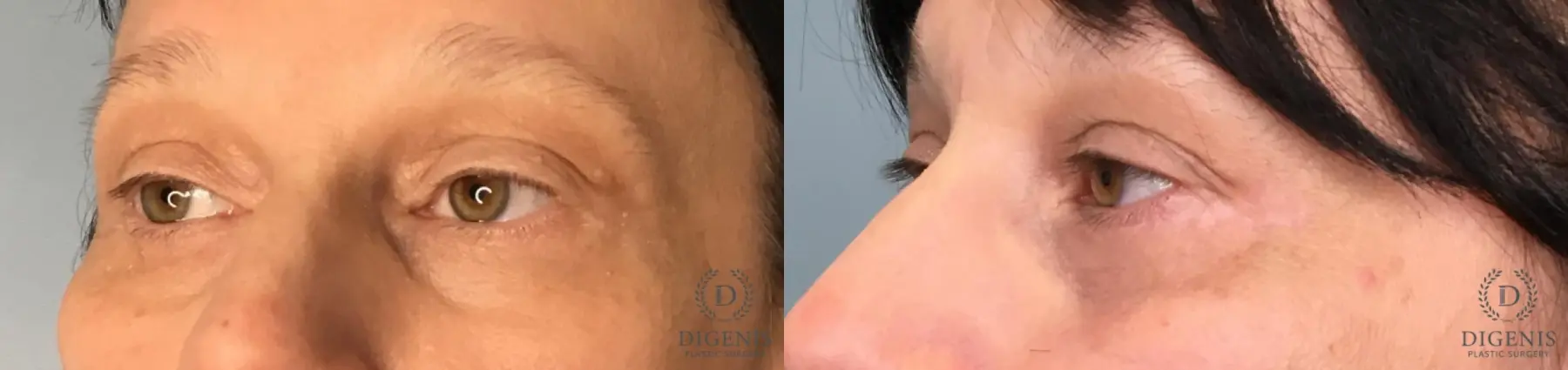 Eyelid Surgery: Patient 3 - Before and After 2