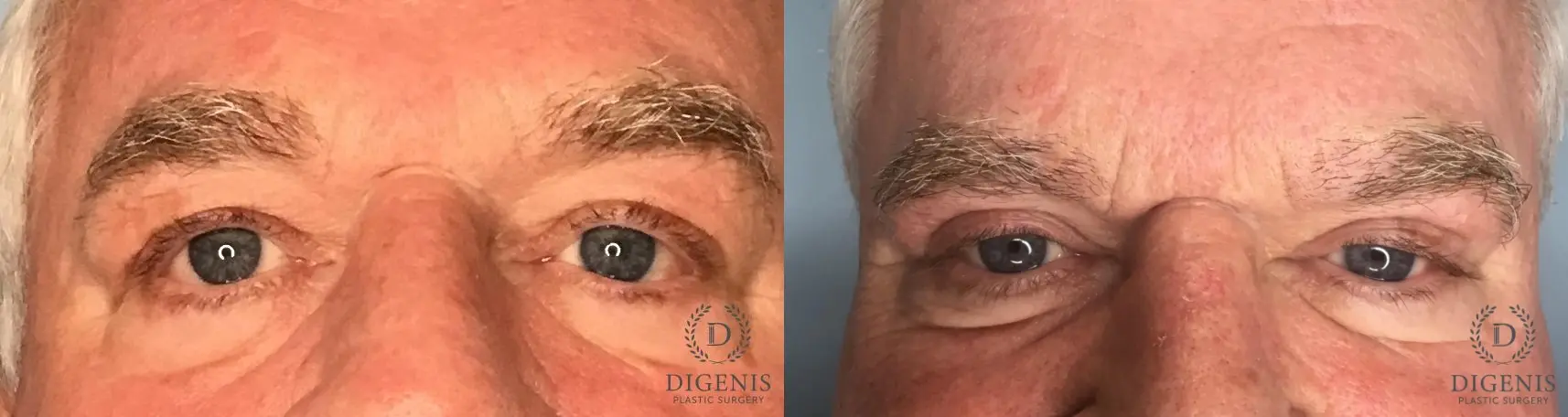 Eyelid Surgery: Patient 8 - Before and After  