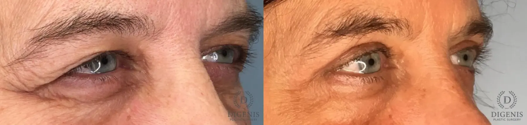 Eyelid Surgery: Patient 68 - Before and After 4