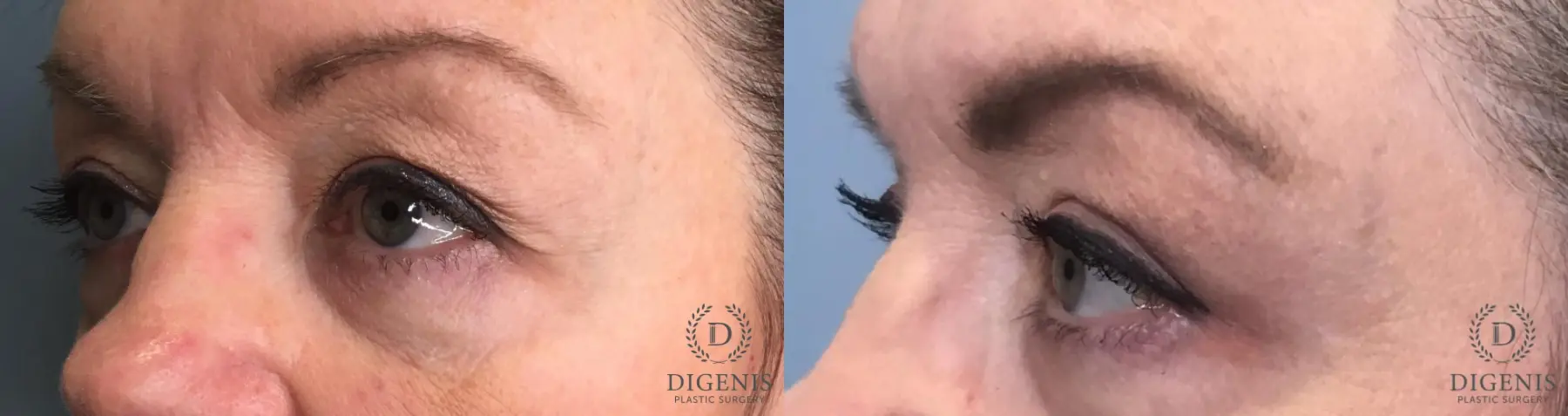 Eyelid Surgery: Patient 9 - Before and After 4