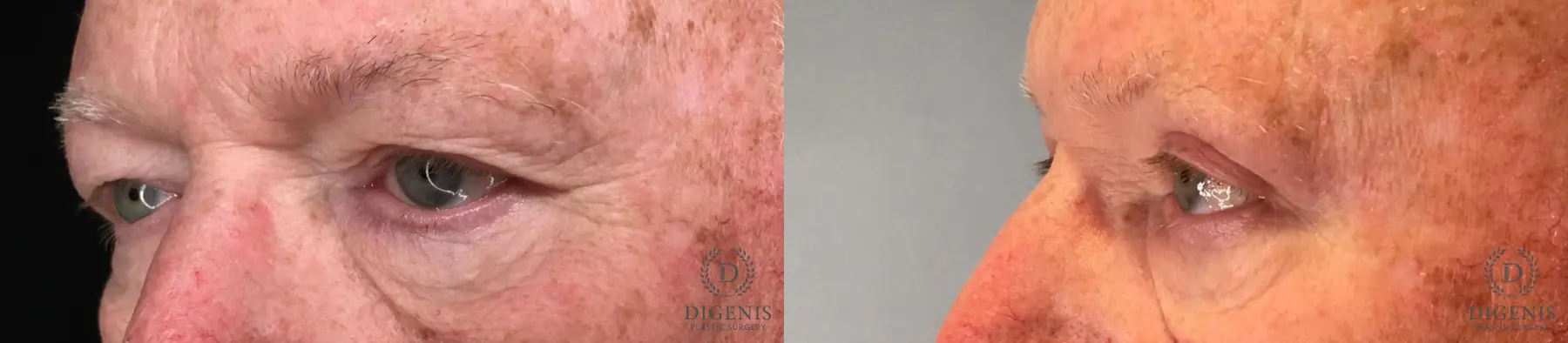 Eyelid Surgery: Patient 54 - Before and After 4
