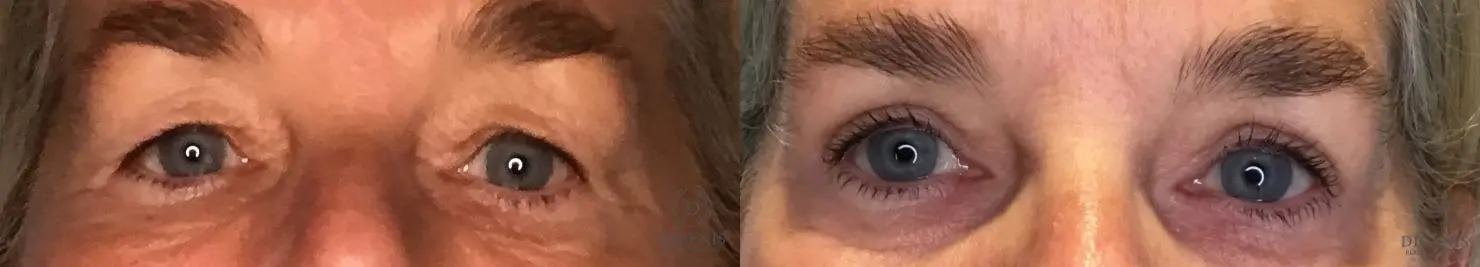 Eyelid Surgery: Patient 76 - Before and After 1