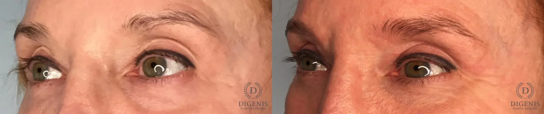 Eyelid Surgery: Patient 7 - Before and After 2