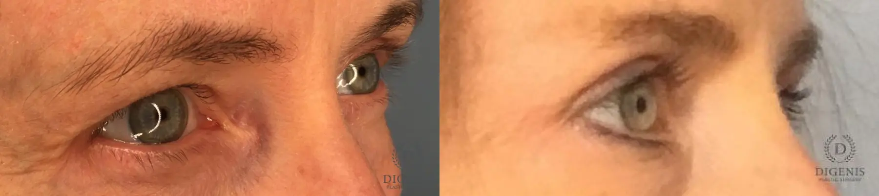 Eyelid Surgery: Patient 66 - Before and After 4