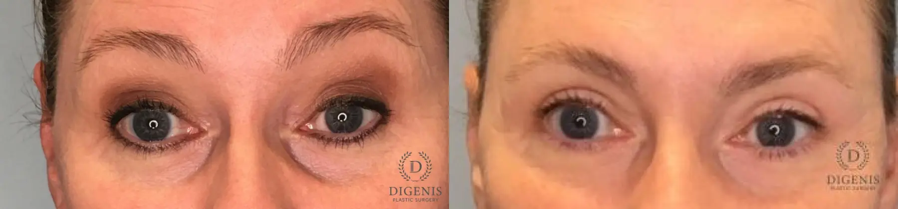 Eyelid Surgery: Patient 12 - Before and After  