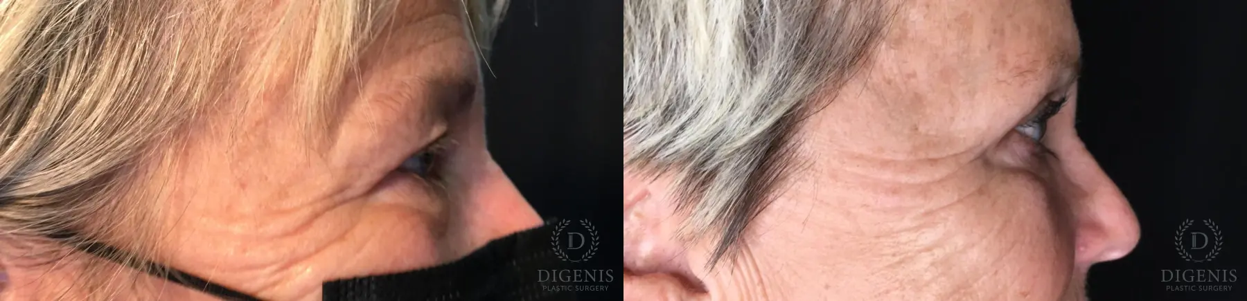 Eyelid Surgery: Patient 55 - Before and After 3