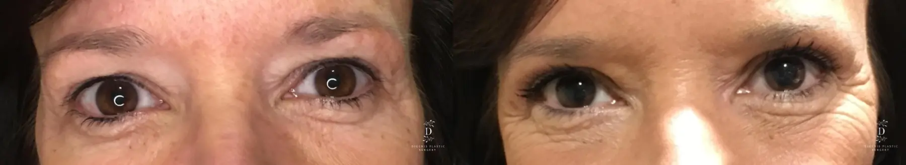 Eyelid Surgery: Patient 27 - Before and After 1