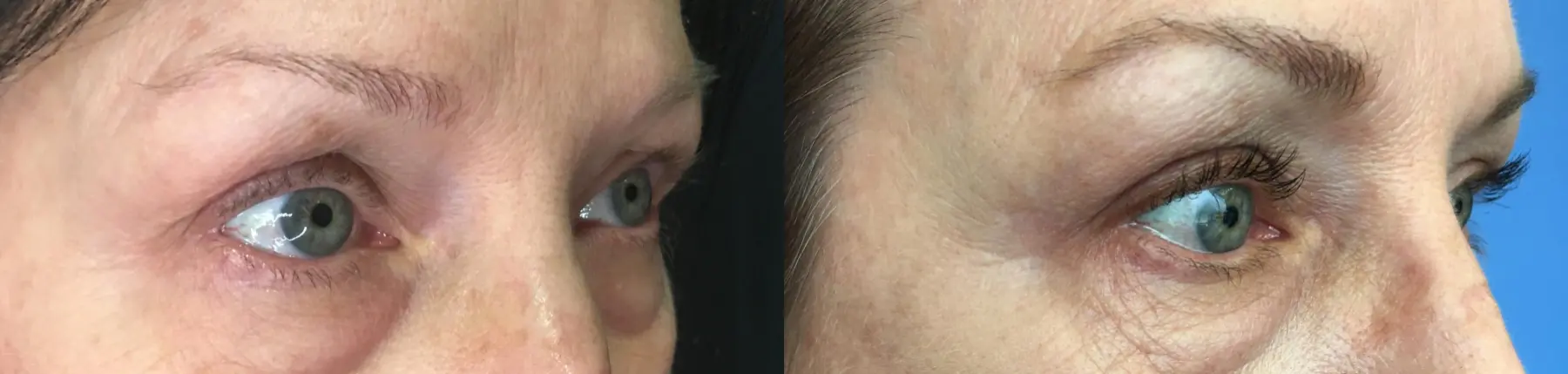 Eyelid Surgery: Patient 24 - Before and After 2