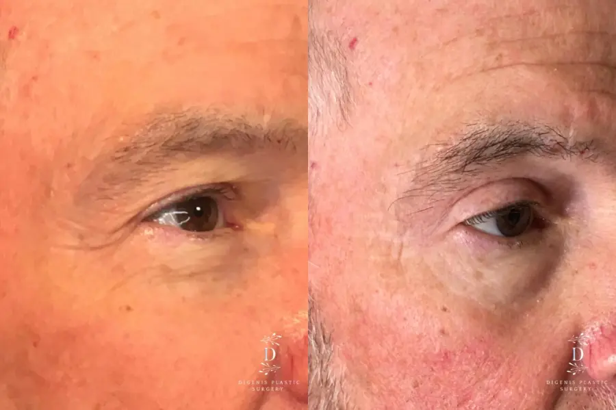 Eyelid Surgery: Patient 19 - Before and After 2
