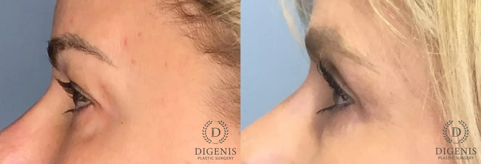Eyelid Surgery: Patient 24 - Before and After 5