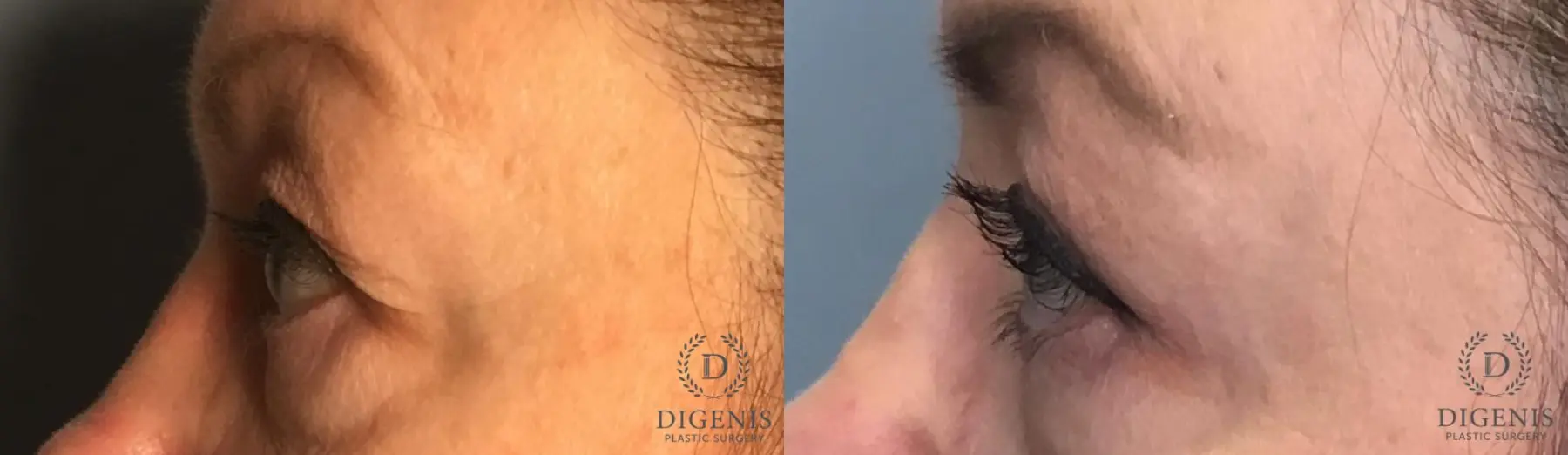 Eyelid Surgery: Patient 9 - Before and After 3