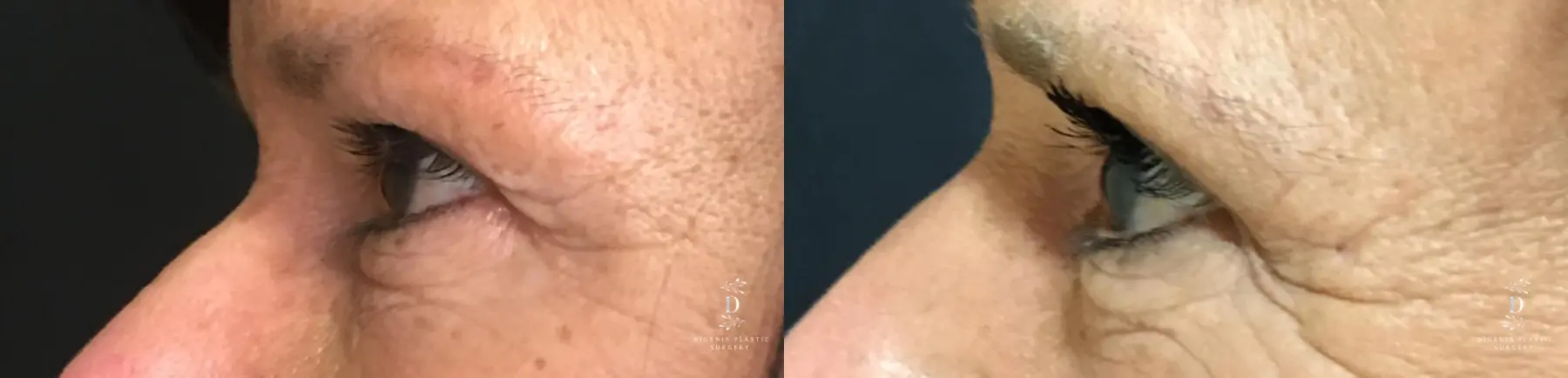 Eyelid Surgery: Patient 27 - Before and After 5