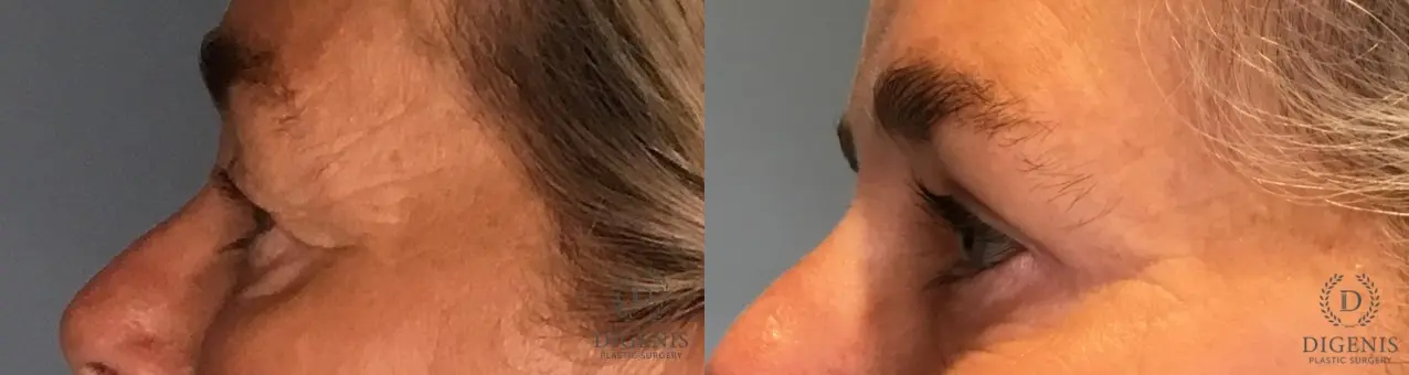 Eyelid Surgery: Patient 76 - Before and After 5
