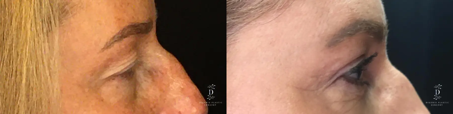 Eyelid Surgery: Patient 13 - Before and After 3